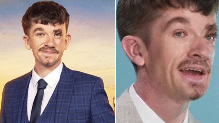 Jonny Heaver with visible facial scarring and a confident smile