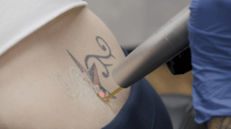 What Makes Experts Stand Out In Laser Tattoo Removal What Makes Experts Stand Out In Laser Tattoo Removal